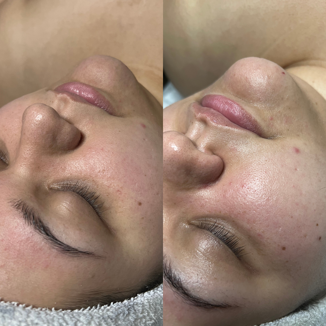 Express Chariibomb Facial